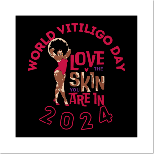 World Vitiligo Day 2024 Motivational Love The Skin You're In Posters and Art